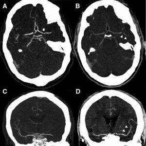 سی تی آنژیوگرافی عروق کرونری | سی تی آنژیوگرافی و آنژیوگرافی عروق کرونری دکتر شاهرخ تقوی❤️فوق تخصص قلب و عروق cta-shahrokh-taghavi-articles