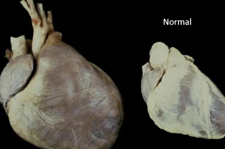 Heart disease symptoms caused by weak heart muscle (dilated cardiomyopathy)