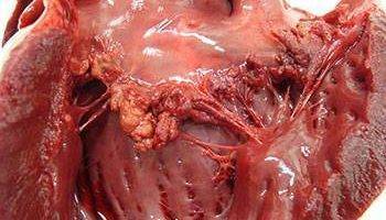 Heart disease symptoms caused by heart infections