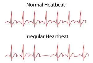 heart arrhythmias