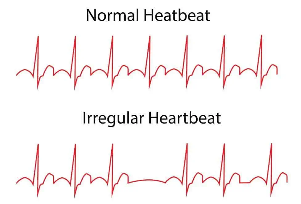 Heart disease symptoms caused by abnormal heartbeats (heart arrhythmias)