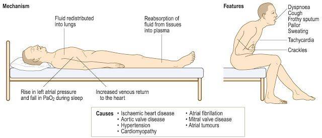 سرفه و بیماریهای قلبی | سرفه و بیماریهای قلبی دکتر شاهرخ تقوی❤️فوق تخصص قلب و عروق Paroxysmal nocturnal dyspnea or paroxysmal nocturnal dyspnoea-دکتر سید شاهرخ تقوی بهترین فوق تخصص قلب در تهران