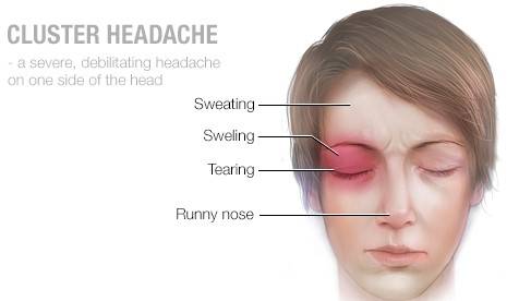 علتهای مهم سردرد میگرنی