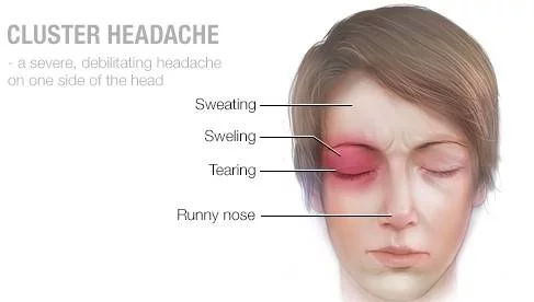 علتهای مهم سردرد میگرنی