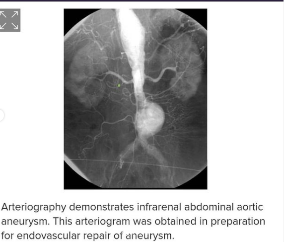 درمان آنوریسم آئورت شکمی1