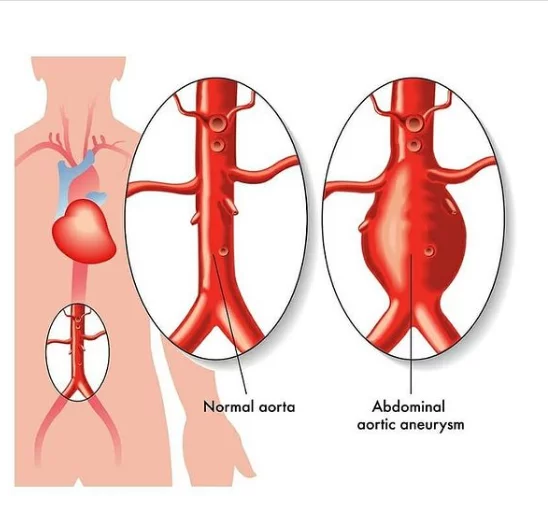 درمان آنوریسم آئورت شکمی1