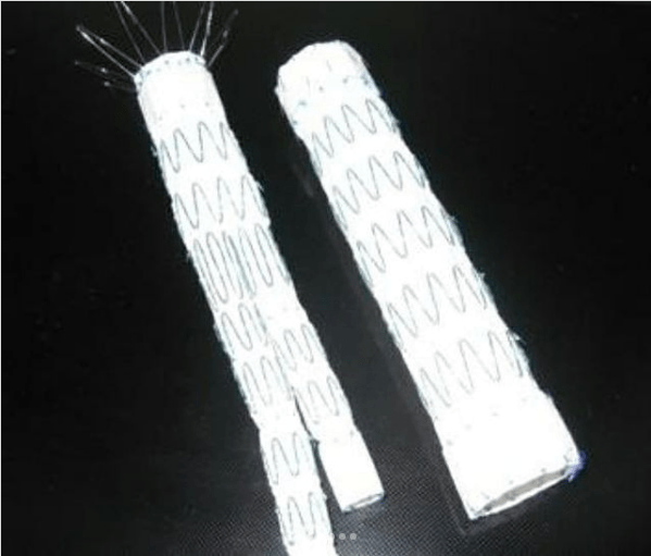 | درمان آنوریسم آئورت شکمی دکتر شاهرخ تقوی❤️فوق تخصص قلب و عروق