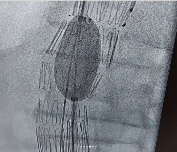 | درمان آنوریسم آئورت شکمی دکتر شاهرخ تقوی❤️فوق تخصص قلب و عروق