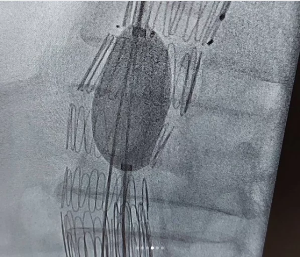 | درمان آنوریسم آئورت شکمی دکتر شاهرخ تقوی❤️فوق تخصص قلب و عروق | درمان آنوریسم آئورت شکمی دکتر شاهرخ تقوی❤️فوق تخصص قلب و عروق