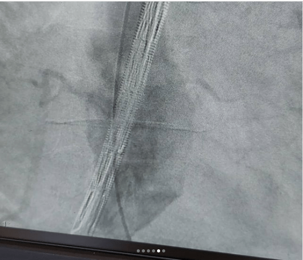 | درمان آنوریسم آئورت شکمی دکتر شاهرخ تقوی❤️فوق تخصص قلب و عروق