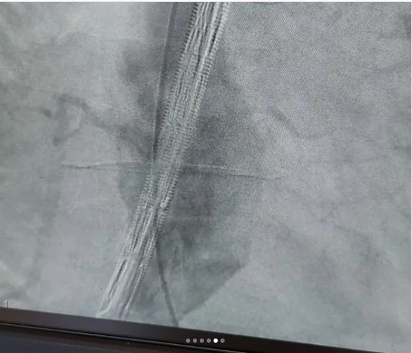 | درمان آنوریسم آئورت شکمی دکتر شاهرخ تقوی❤️فوق تخصص قلب و عروق | درمان آنوریسم آئورت شکمی دکتر شاهرخ تقوی❤️فوق تخصص قلب و عروق