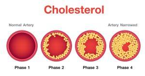 high cholesterol- کلسترول بالای خون