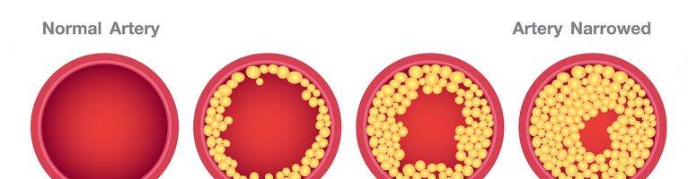 کلسترول: آنچه باید در مورد کلسترول خون بالا بدانید