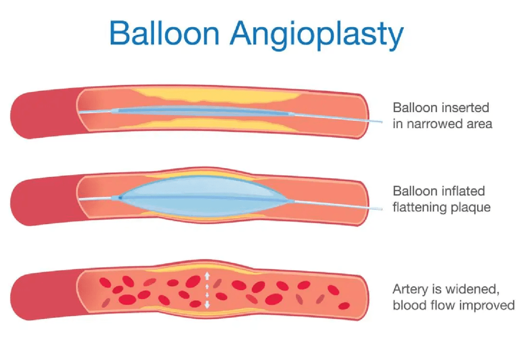 انواع استنت‌های قلبی