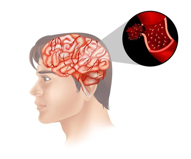سکته مغزی | Stroke: انواع، علائم و نشانهها دکتر شاهرخ تقوی❤️فوق تخصص قلب و عروق تعریف سکته مغزی
